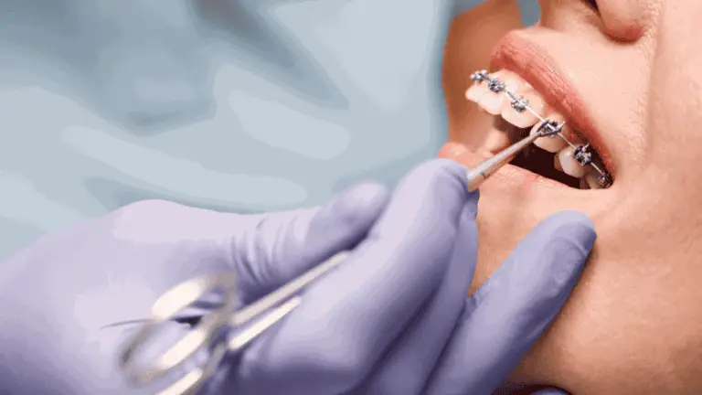 Orthodontist adjusting metal braces and elastic ligatures on a patient's teeth