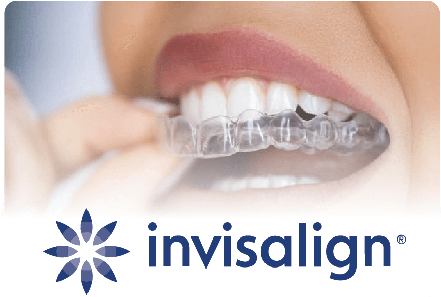 Invisalign in Raleigh, NC: What to Expect from Start to Finish 1 Invisalign Braces from Gladwell in Raleigh