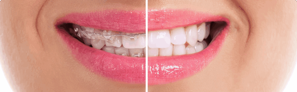 Orthodontic Treatment